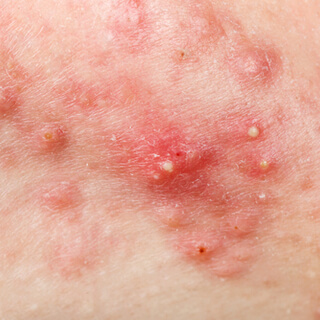 6. العقيدات Nodules