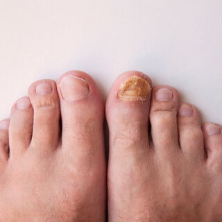 فطريات أظافر القدم (Toenail fungus)