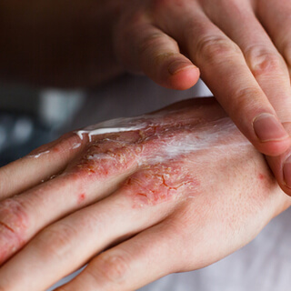 علاج السمكية