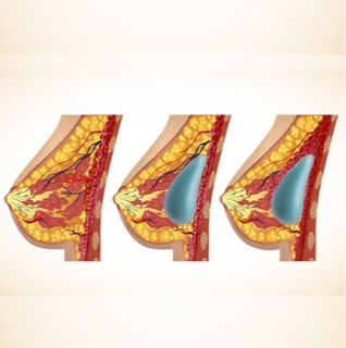 1. التورم في الثدي ومحيطه