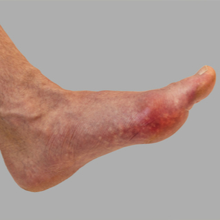 3. الاحمرار والتورم المؤلم