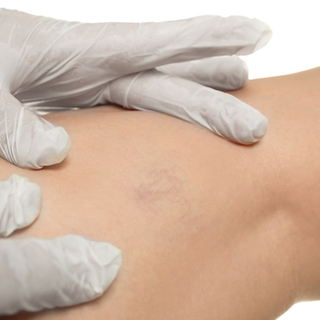 تشخيص مرض الدوالي العنكبوتية