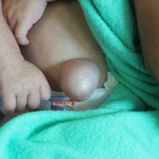 أعراض الفتق السري الخانق عند الرضع