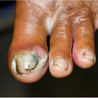 أظافر سوداء مخضرة