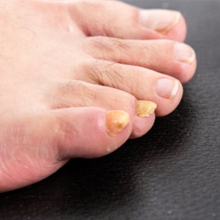 أظافر صفراء