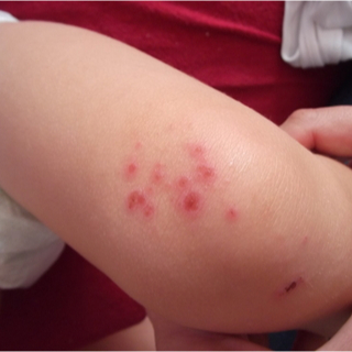 حساسية الجلد عند الأطفال ، الصور ، طب الويب