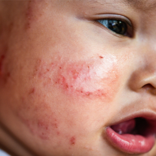 حساسية الجلد عند الأطفال ، الصور ، طب الويب