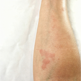 أسباب مرض الذئبة الحمراء