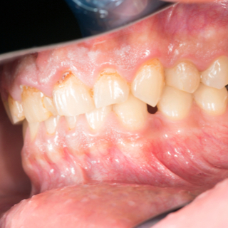 سبب حدوث أمراض اللثة