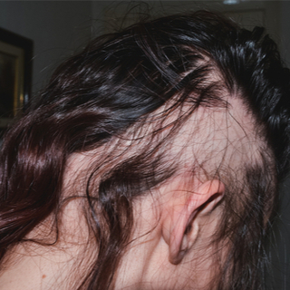 أنواع داء الثعلبة