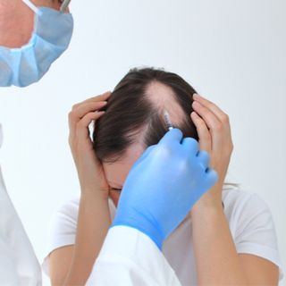  علاج داء الثعلبة