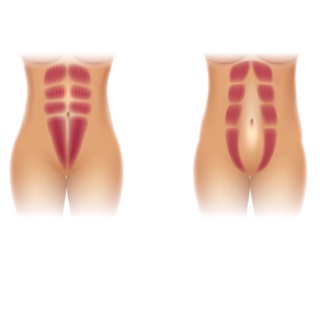 الانفصال العضلي