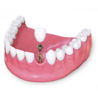 1. زراعة الأسنان