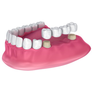 2. جسور الأسنان الثابتة