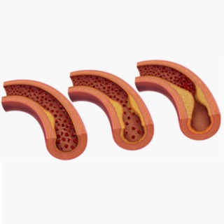 تصلب الشرايين بالصور