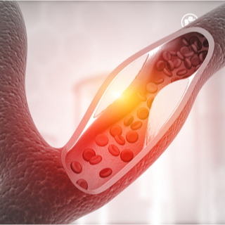 أعراض تصلب الشرايين