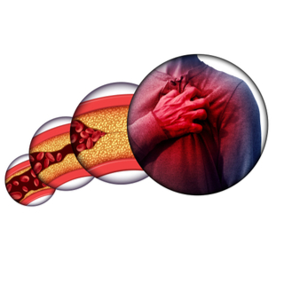 أعراض تصلب شرايين القلب