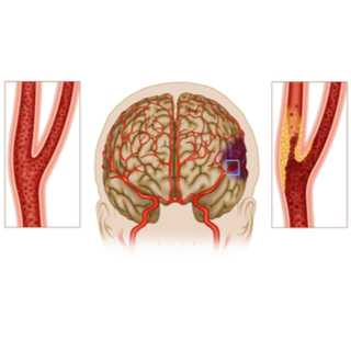 أعراض تصلب شرايين الدماغ