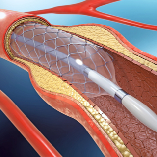 علاج تصلب الشرايين