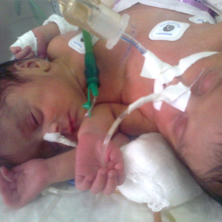 التوأم الملتصق