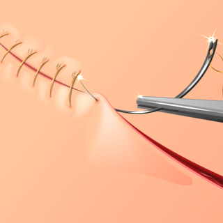 إتمام الخياطة