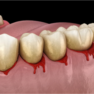 التهاب اللثة التقرحي الناخر الحاد
