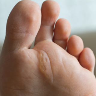 كيف يتشكل مسمار القدم؟