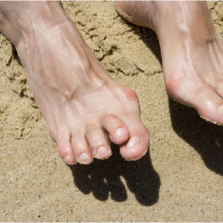 أسباب الإصابة بمسمار القدم