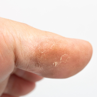 أعراض الإصابة بمسمار القدم