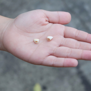 فقدان الأسنان اللبنية