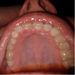 الغدد اللعابية الصغيرة: الغدد الحنكية  