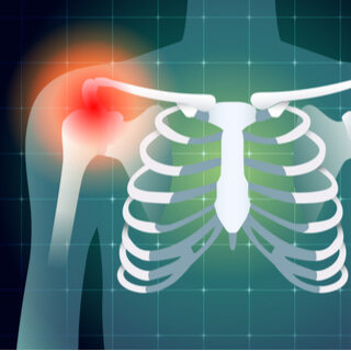 انفصال الكتف 