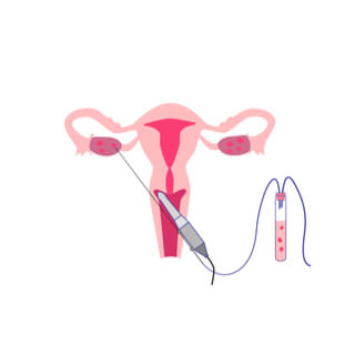 3. استرجاع البيض