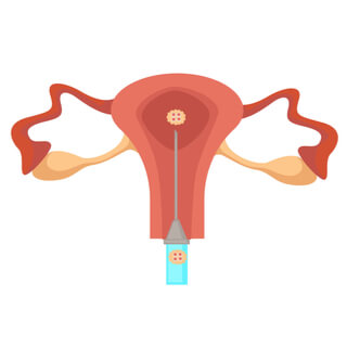 6. نقل الأجنة للرحم