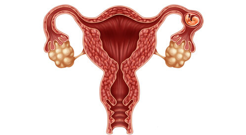 الحمل في قناة فالوب