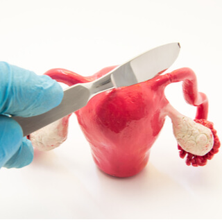 استئصال قناة فالوب والحمل