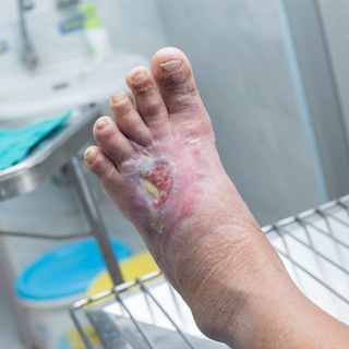 4. قدم السكري