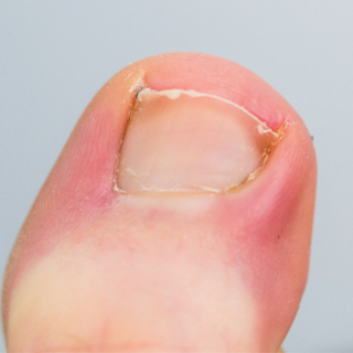 5. الظفر الناشب