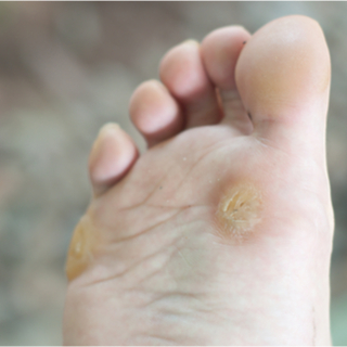 8. مسامير اللحم 