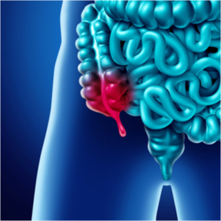 التهاب الزائدة الدودية