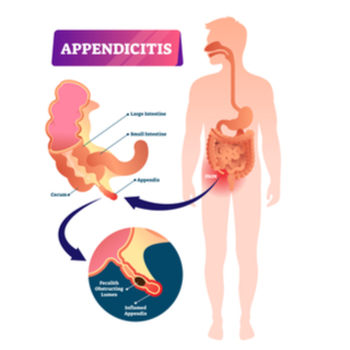 أسباب التهاب الزائدة الدودية