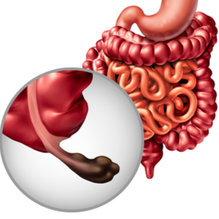 سرطان الزائدة الدودية