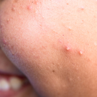 علاج الرؤوس السوداء والبيضاء