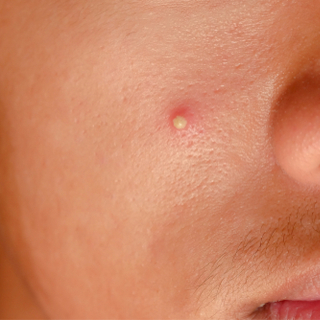 البثور المتقيحة