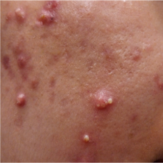 عقيدات وكيسات حب الشباب