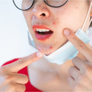 حب الشباب الناتج عن الكمامة (Maskne)