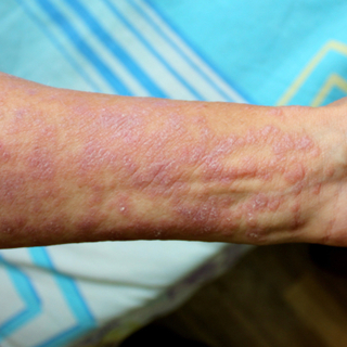 الحزاز المسطح (Lichan planus)