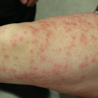 التهاب الجلد التماسي (Contact dermatitis)