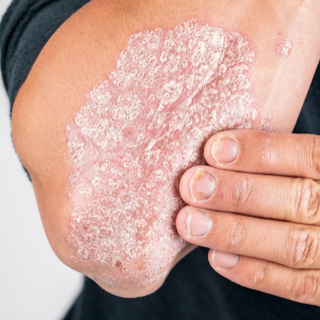 الصدفية (Psoriasis)