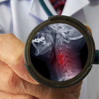 علاج آلام الرقة الناتج عن تضيق العامود الفقري